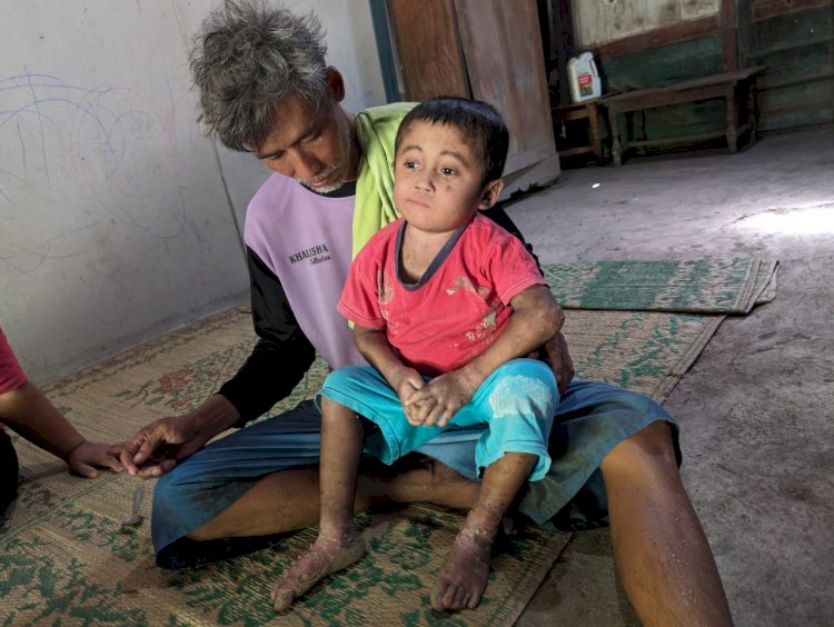 Jayus bersama Alfi Azka yang mengidap penyakit kulit langka epidermolysis bullosa (EB)/Ist